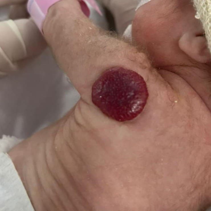 Hemangioma infantil nodular na mão de um recém-nascido durante avaliação médica