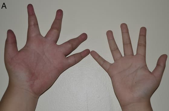 Malformação arteriovenosa na mão: aumento e vermelhidão em comparação com a mão saudável