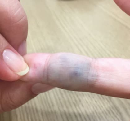 Malformação venosa no dedo: coloração azulada característica