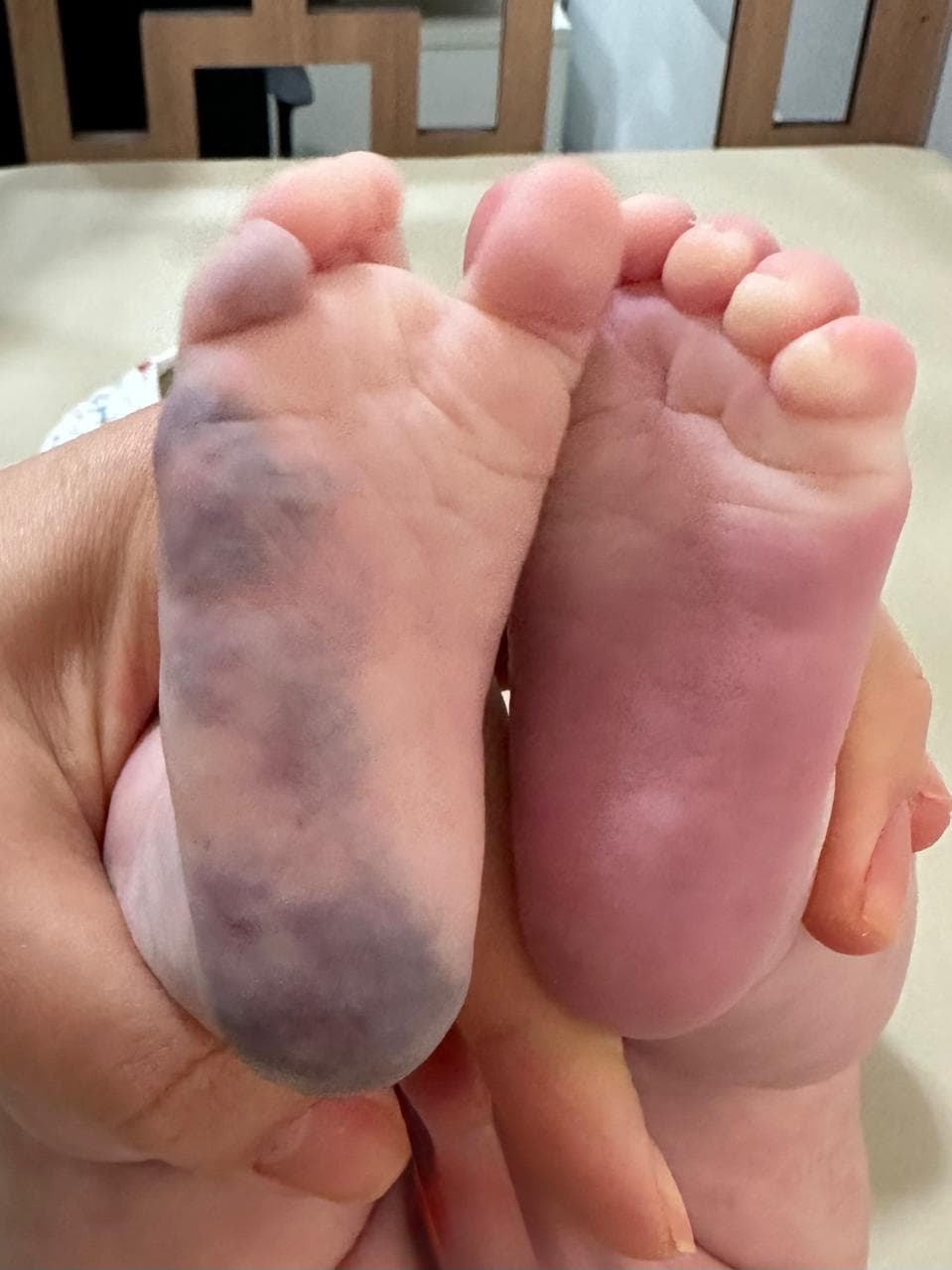 Malformação venosa na planta do pé de um bebê