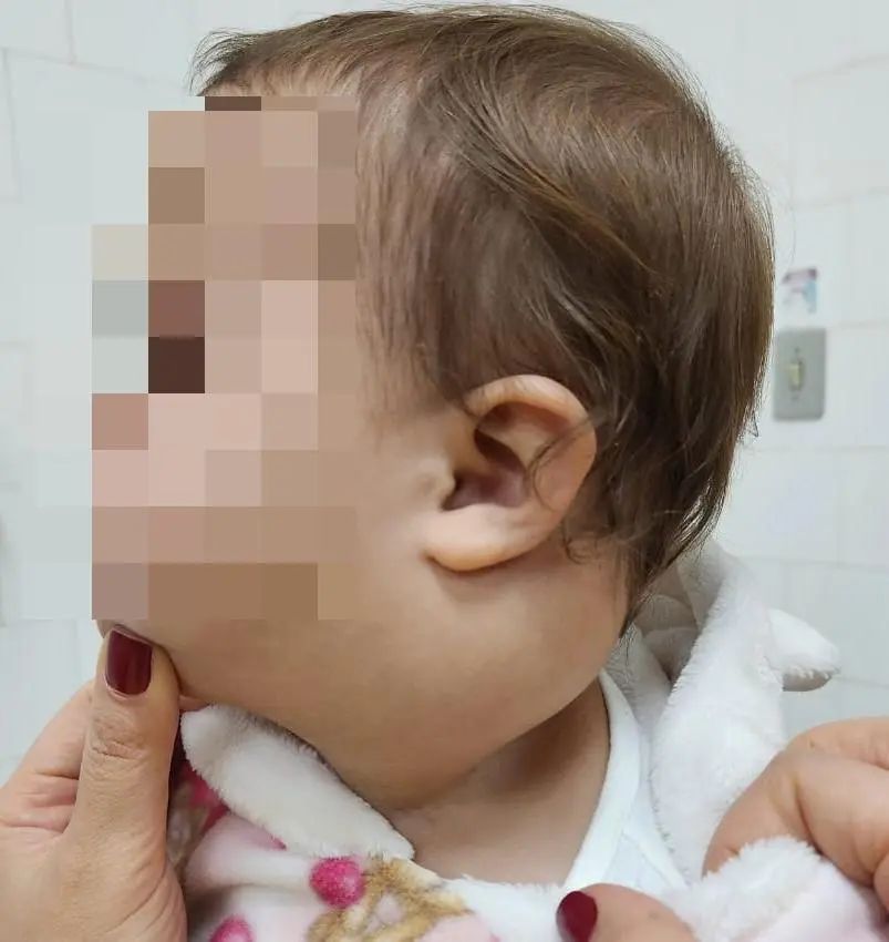 Linfangioma cervical em bebê: aumento de volume no pescoço e na mandíbula