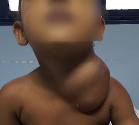 Criança com malformação linfática cervical volumosa
